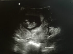 Baby makes Six | We Are Pregnant! pregnancy ultrasound 10 weeks